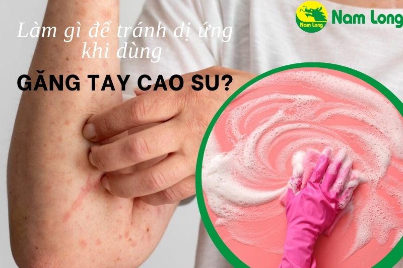 Dị ứng găng tay cao su Nam Long 